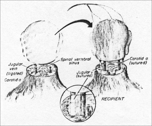 Transplantacija ljudske glave: kontroverzni postupak uspješno proveden na lešu; neposredan postupak uživo
